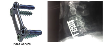 Placa Cervical