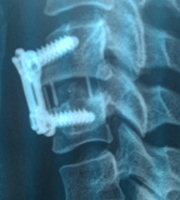 Placa Cervical