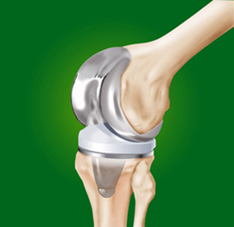 Prótesis de rodilla