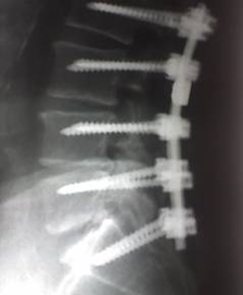 estenosis