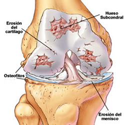 Patología degenerativa de rodilla