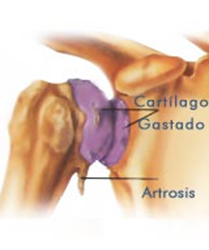 Patología degenerativa de hombro