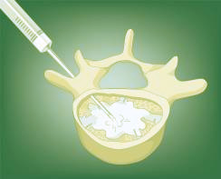 Cifoplastia